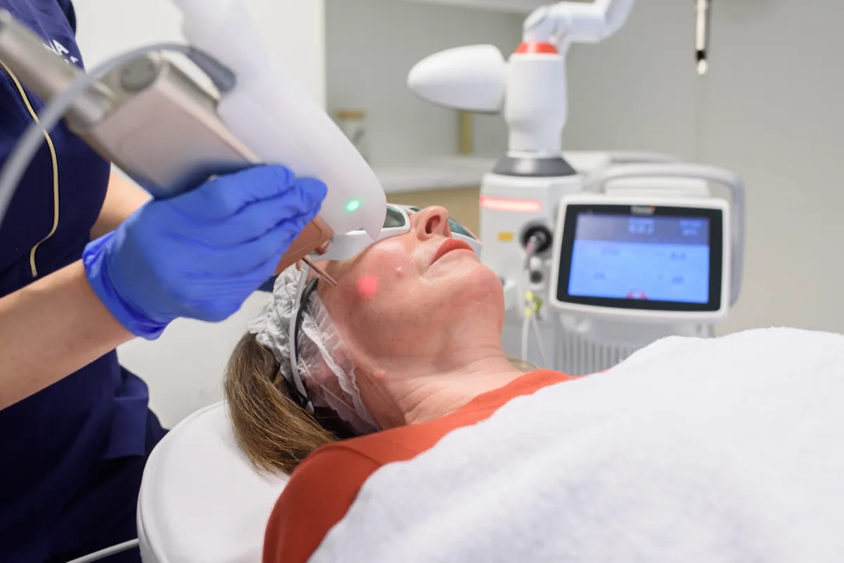 Laserbehandling av ansikt med Fotona-laseren